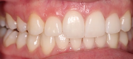 Before and After Invisalign Treatment Kingston Before and After Invisalign Treatment Kingston