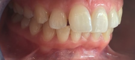 Before and After Invisalign Treatment Kingston Before and After Invisalign Treatment Kingston