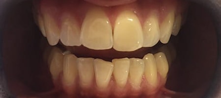 Before and After Invisalign Treatment Kingston Before and After Invisalign Treatment Kingston