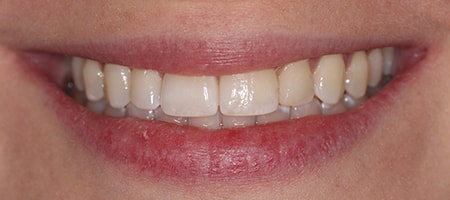 Before and After Invisalign Treatment Kingston Before and After Invisalign Treatment Kingston