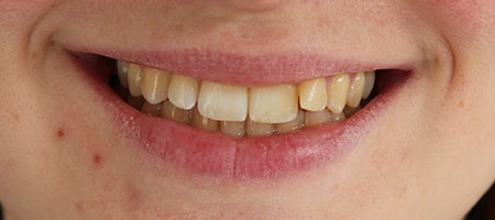 Before and After Invisalign Treatment Kingston Before and After Invisalign Treatment Kingston