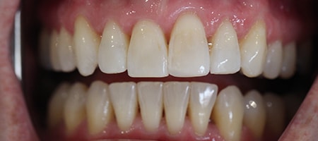 Before and After Invisalign Treatment Kingston Before and After Invisalign Treatment Kingston