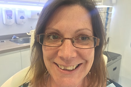 Before and After Invisalign Treatment Kingston Before and After Invisalign Treatment Kingston