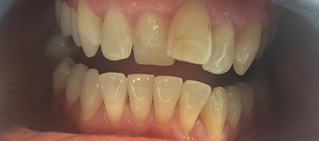 Before and After Invisalign Treatment Kingston Before and After Invisalign Treatment Kingston