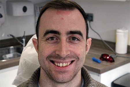 Before and After Invisalign Treatment Kingston Before and After Invisalign Treatment Kingston