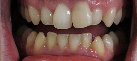 Before and After Invisalign Treatment Kingston Before and After Invisalign Treatment Kingston