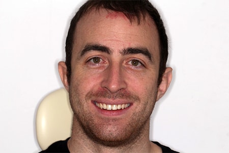 Before and After Invisalign Treatment Kingston Before and After Invisalign Treatment Kingston