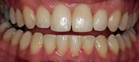Before and After Invisalign Treatment Kingston Before and After Invisalign Treatment Kingston