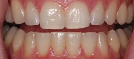 Before and After Invisalign Treatment Kingston Before and After Invisalign Treatment Kingston