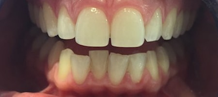 Before and After Invisalign Treatment Kingston Before and After Invisalign Treatment Kingston