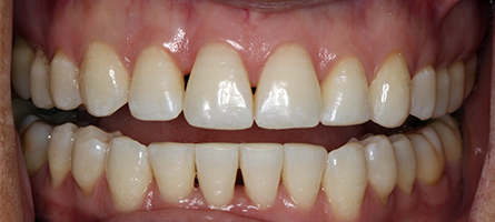 Before and After Invisalign Treatment Kingston Before and After Invisalign Treatment Kingston
