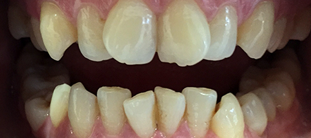 Before and After Invisalign Treatment Kingston Before and After Invisalign Treatment Kingston