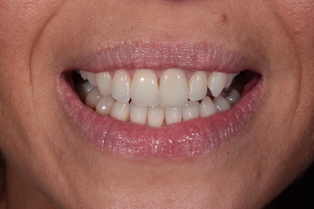 Before and After Invisalign Treatment Kingston