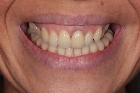 Before and After Invisalign Treatment Kingston