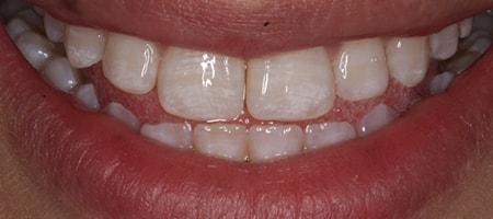 Before and After Invisalign Treatment Kingston Before and After Invisalign Treatment Kingston