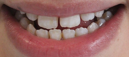 Before and After Invisalign Treatment Kingston Before and After Invisalign Treatment Kingston