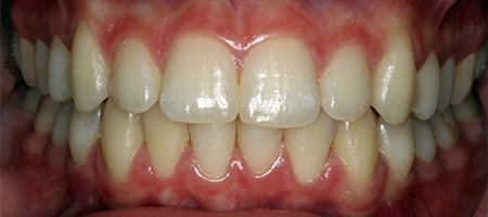 Before and After Invisalign Treatment Kingston Before and After Invisalign Treatment Kingston
