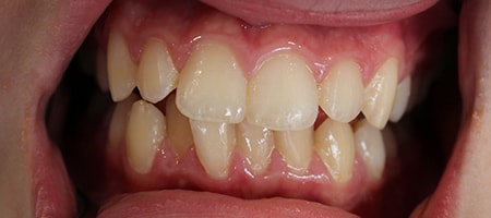 Before and After Invisalign Treatment Kingston Before and After Invisalign Treatment Kingston