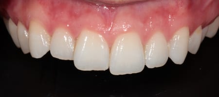 Composite Bonding Cases