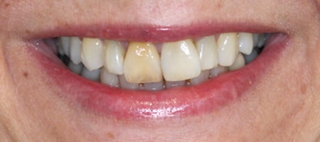 Before cosmetic Treatment Smile Rooms Kingston