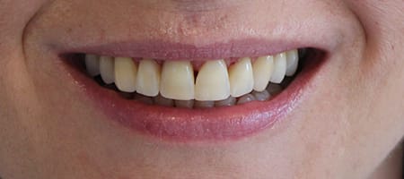 Gapped teeth after - smile kingston, kingston upon thames 