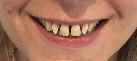 Gapped teeth before - smile kingston, kingston upon thames 