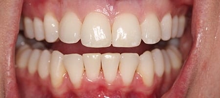 crowded teeth after Invisalign