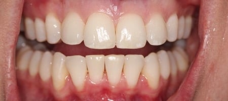 crowded teeth after Invisalign 