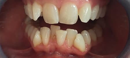 Before Invisalign Treatment Reading Smiles 