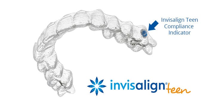 Invisalign braces for teens compliance indicator 