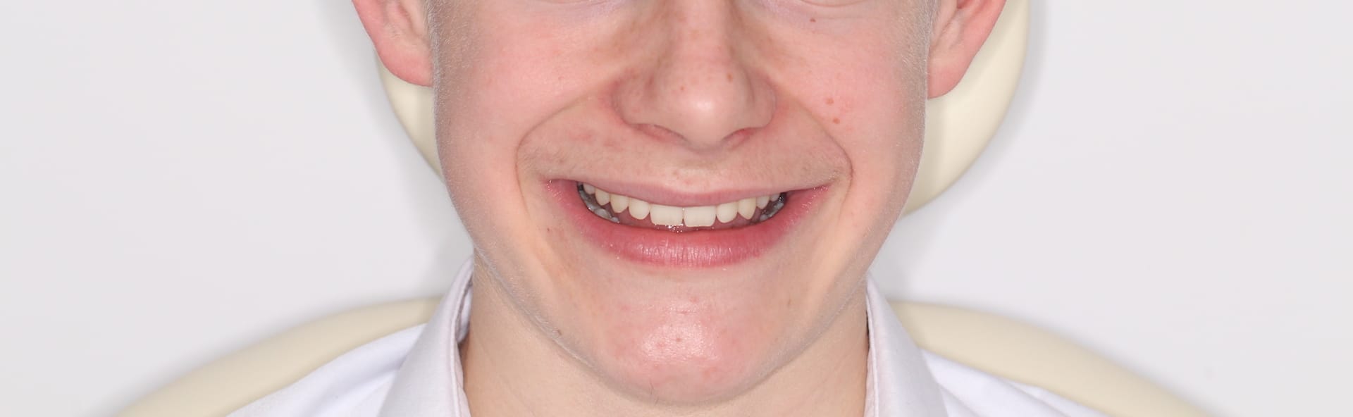 Ewan's final results from Invisalign braces 