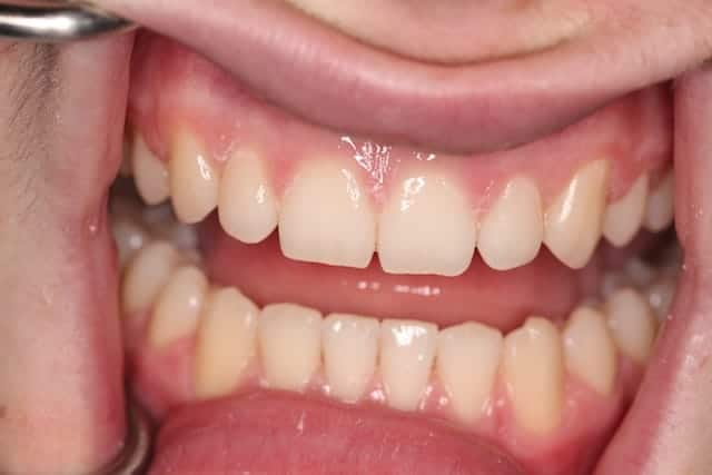 Ewan's teeth after Invisalign