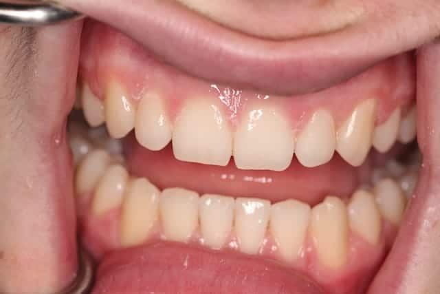 Ewan's teeth after Invisalign 