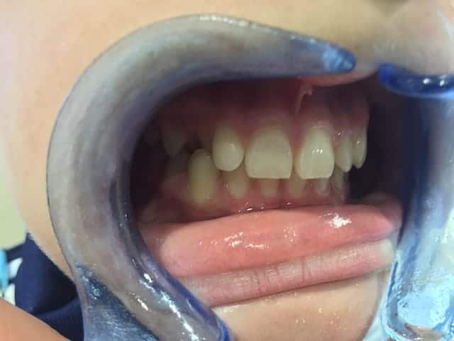Ewan's teeth before Invisalign side view