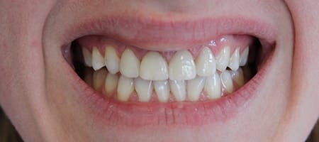 After Invisalign Treatment Reading Smiles 